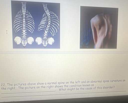 The pictures above show a normal spine on the left and an abnormal spine curvature on 
_ 
the right. The picture on the right shows the condition known as 
. What might be the cause of this disorder? 
_