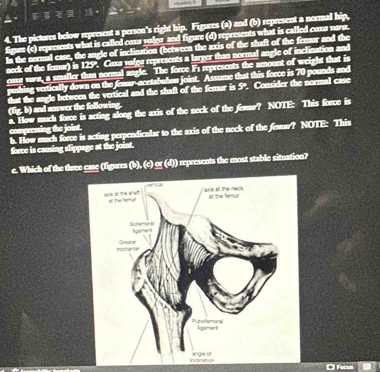 The pictures below represent a person's right hip. Figures (a) and (b) represent a normal hip,
figure (e) represents what is called coxa valgu and figure (d) represents what is called cαxα νara.
In the normal case, the angle of inclination (between the axis of the shaft of the fernur and the
neck of the femur) is 125°. Coxa valga represents a larger than normal angle of inclination and
coxa wara, a smaller than normal angle. The force F1 represents the amount of weight that is
pushing vertically down on the femur-ocetabulum joint. Assume that this force is 70 pounds and
that the angle between the vertical and the shaft of the femur is 5°. Consider the normal case
(fig. b) and answer the following.
a. How much force is acting along the axis of the neck of the femur? NOTE: This force is
compressing the joint.
b. How much force is acting perpendicular to the axis of the neck of the femur? NOTE: This
force is causing slippage at the joint.
e. Which of the three case (figures (b), (c) or (d)) represents the most stable situation?
Focus