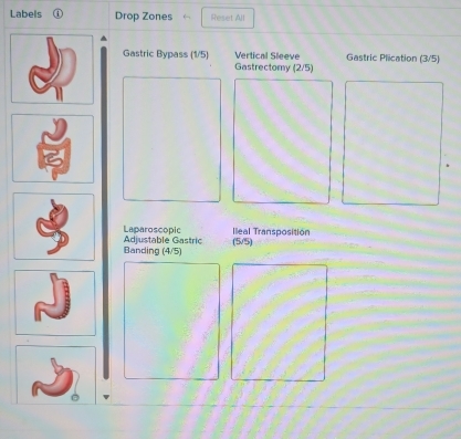 Labels ① Drop Zones Reset All 
Gastric Bypass (1/5) Vertical Sleeve Gastric Plication (3/5)
Gastrectomy (2/5)
Ileal Transposition 
Laparoscopic Adjustable Gastric 
Banding (4/5) (5/5)