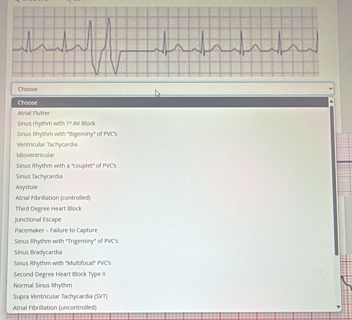 Solved: Choose Choose Atrial Flutter Sinus rhythm with 1° AV Block ...