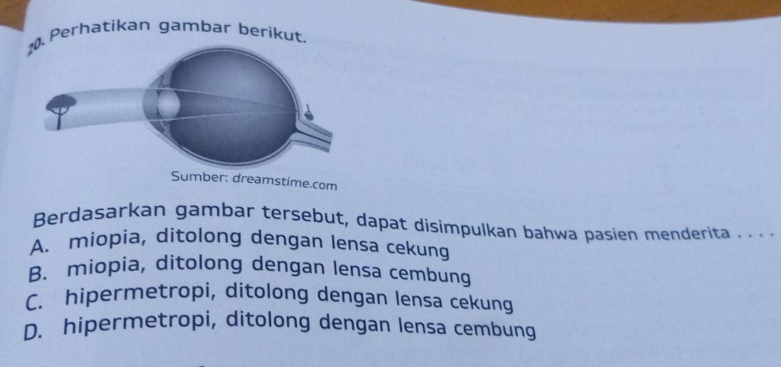 Perhatikan gambar berikut.
Sumber: dreamstime.com
Berdasarkan gambar tersebut, dapat disimpulkan bahwa pasien menderita . . . .
A. miopia, ditolong dengan lensa cekung
B. miopia, ditolong dengan lensa cembung
C. hipermetropi, ditolong dengan lensa cekung
D. hipermetropi, ditolong dengan lensa cembung