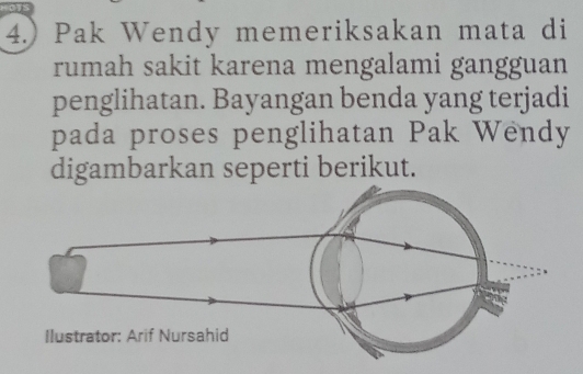 4.) Pak Wendy memeriksakan mata di 
rumah sakit karena mengalami gangguan 
penglihatan. Bayangan benda yang terjadi 
pada proses penglihatan Pak Wendy 
digambarkan seperti berikut. 
Ilustrator: Arif Nursahid