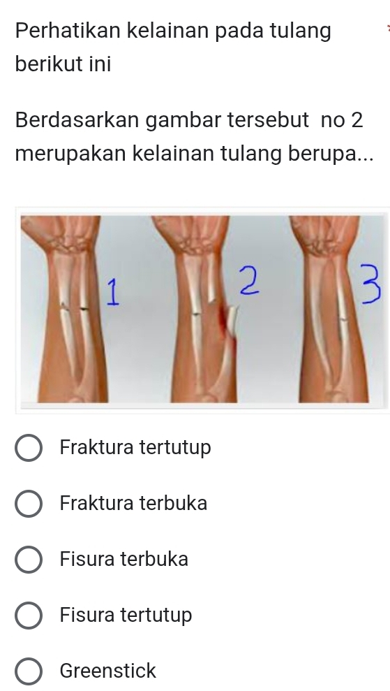 Perhatikan kelainan pada tulang
berikut ini
Berdasarkan gambar tersebut no 2
merupakan kelainan tulang berupa...
Fraktura tertutup
Fraktura terbuka
Fisura terbuka
Fisura tertutup
Greenstick