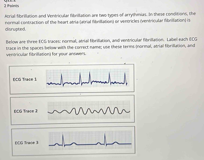 Solved: Atrial fibrillation and Ventricular fibrillation are two types ...