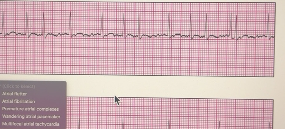 Solved: (Click to select) Atrial flutter Atrial fibrillation Premature ...