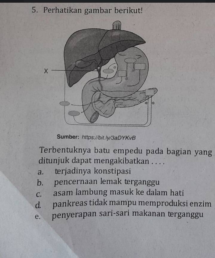 Perhatikan gambar berikut!
Sumber: https://bit.ly/3aDYKvB
Terbentuknya batu empedu pada bagian yang
ditunjuk dapat mengakibatkan . . . .
a. terjadinya konstipasi
b. pencernaan lemak terganggu
c. asam lambung masuk ke dalam hati
d. pankreas tidak mampu memproduksi enzim
e. penyerapan sari-sari makanan terganggu