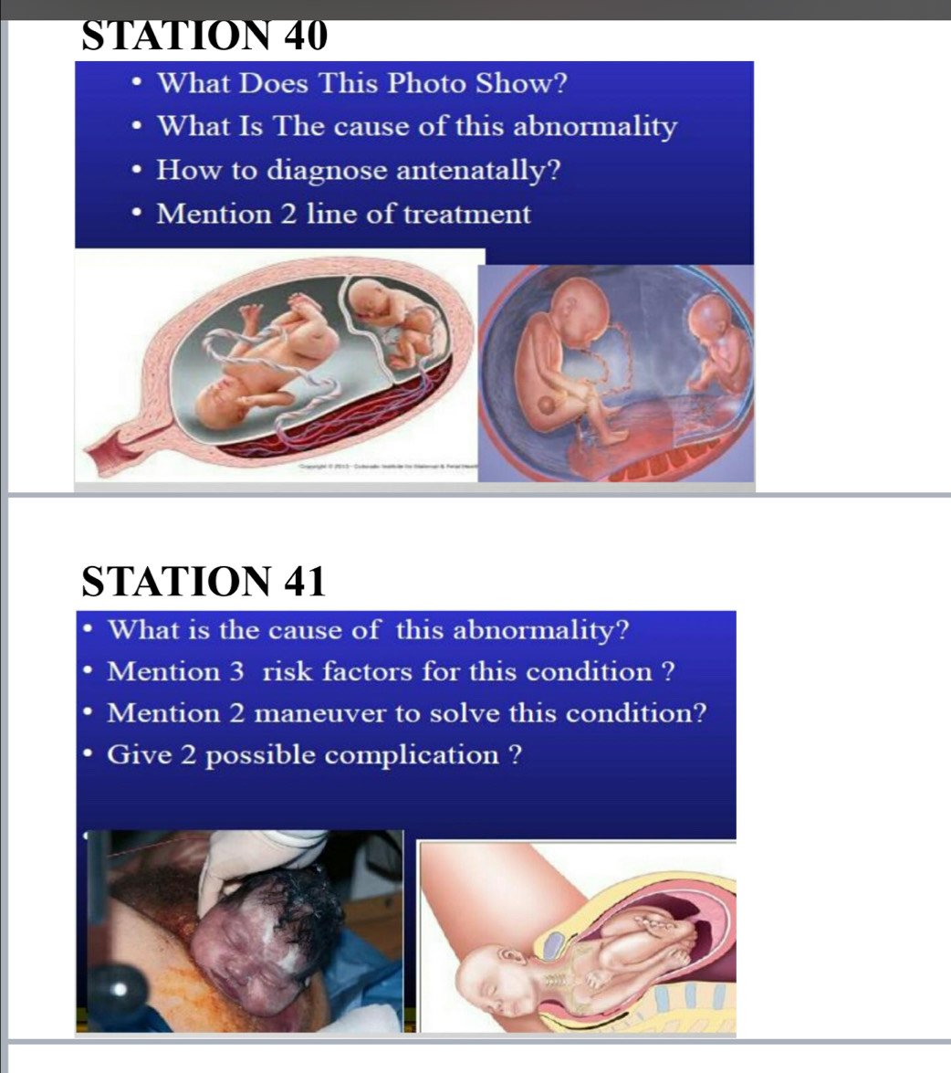 STATION 40 
What Does This Photo Show? 
What Is The cause of this abnormality 
How to diagnose antenatally? 
Mention 2 line of treatment 
STATION 41 
What is the cause of this abnormality? 
Mention 3 risk factors for this condition ? 
Mention 2 maneuver to solve this condition? 
Give 2 possible complication ?