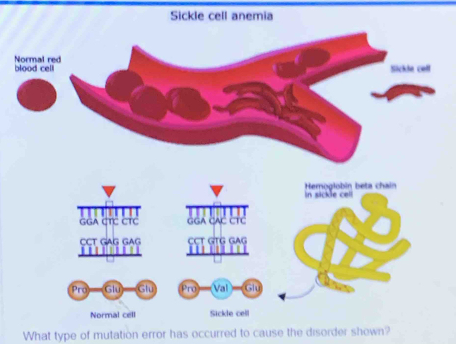 Sickle cell anemia 
b 
What type of mutation error has occurred to cause the disorder shown?